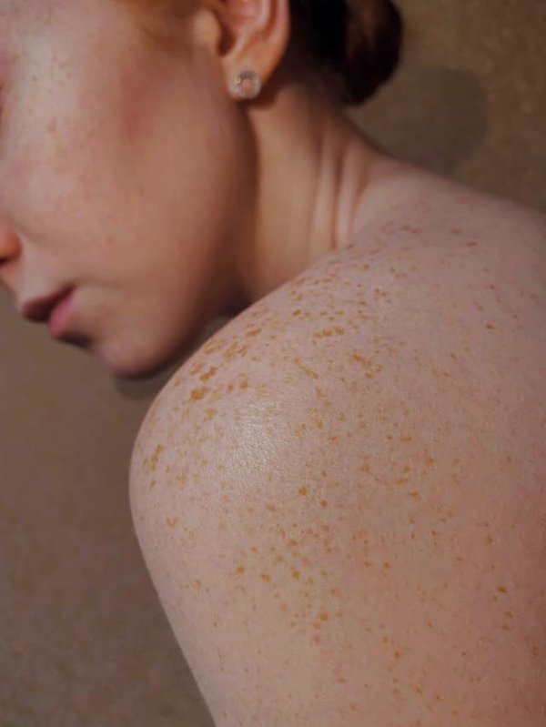 Comment choisir le bon exfoliant pour une peau sensible et sujette à l'acné?
